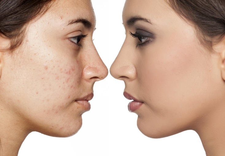 Why Are Black Spots Acne Scars Difficult to Disappear?